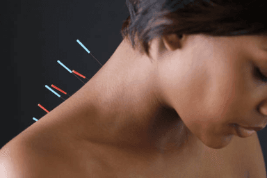 Image for Acupuncture Treatment